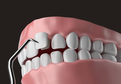 Veneers