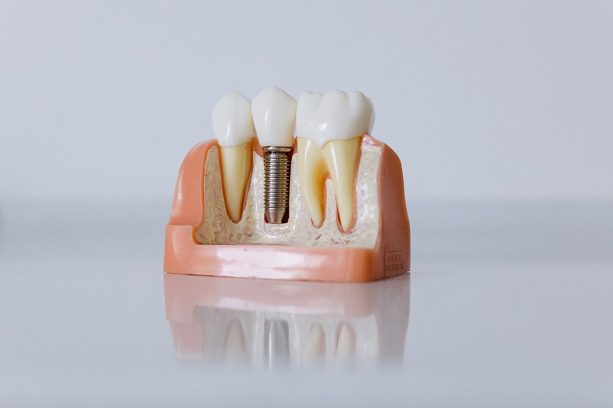 Are dental implants right for you?
