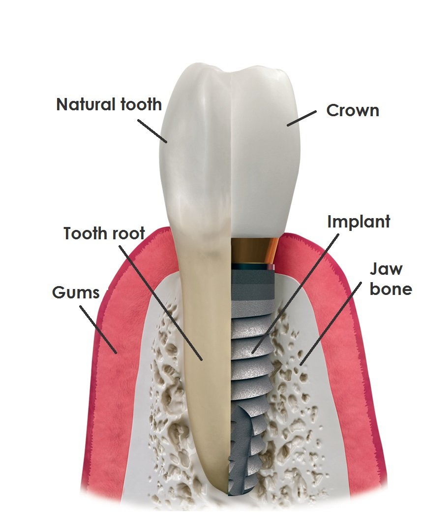 Are dental implants right for you?