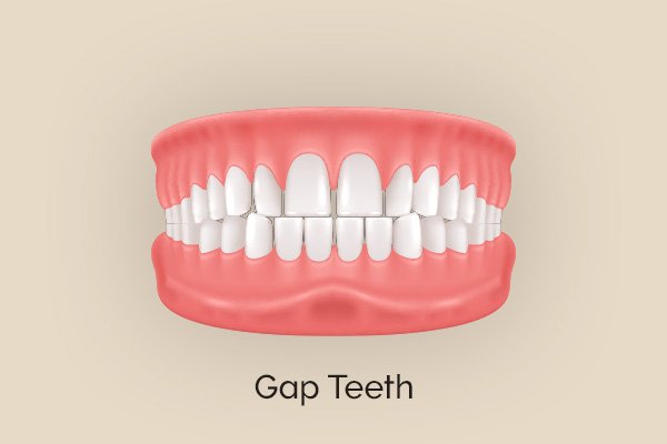 Best Invisalign provider in Highlands