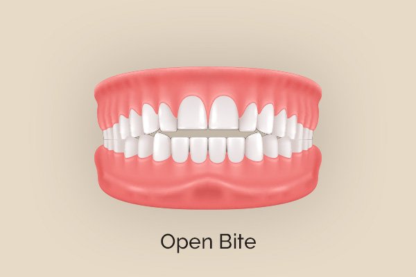 Best Invisalign provider in Highlands