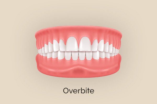 Best Invisalign provider in Highlands